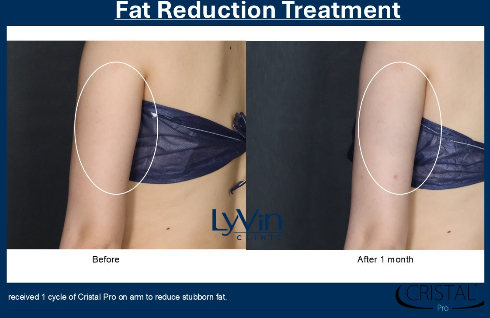 X-Wave Before and After - First